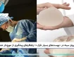 پروتز سینه در پوست های بسیار نازک؛ راهکارهای پیشگیری از موج دار شدن
