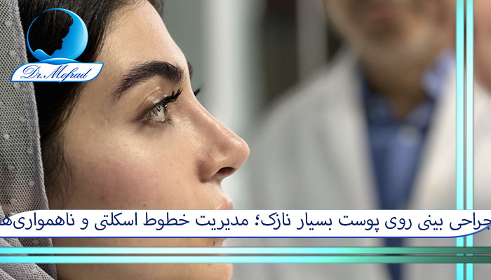 جراحی بینی روی پوست بسیار نازک؛ مدیریت خطوط اسکلتی و ناهمواری‌ها