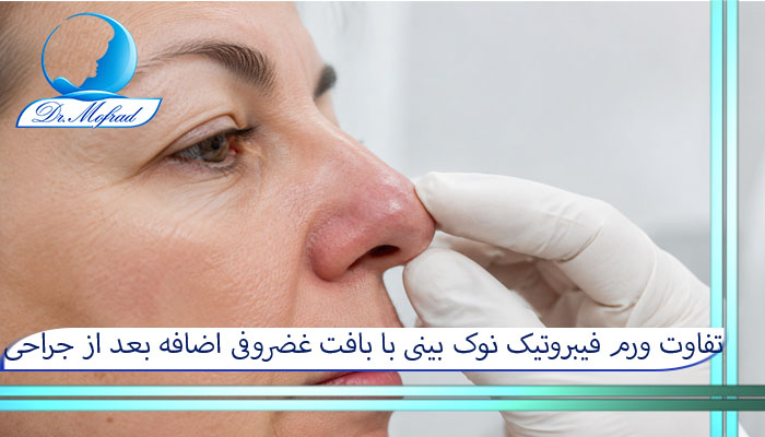 تفاوت ورم فیبروتیک نوک بینی با بافت غضروفی اضافه بعد از جراحی