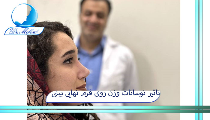 تاثیر نوسانات وزن روی فرم نهایی بینی