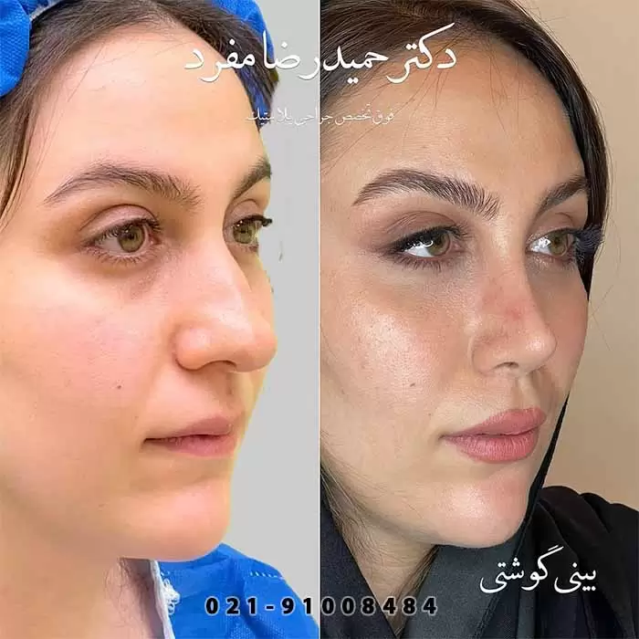 عکس قبل و بعد عمل بینی گوشتی